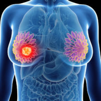 illustration of a womans mammary glands cancer