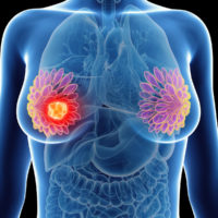 illustration of a womans mammary glands cancer illustration of a womans mammary glands cancer